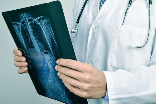 Spine Injury After A Car Accident